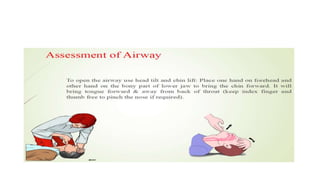 Cardiopulmonary resucitation