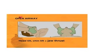 Cardiopulmonary resucitation