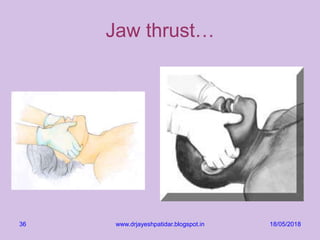 18/05/2018www.drjayeshpatidar.blogspot.in36
Jaw thrust…
 