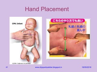 18/05/2018www.drjayeshpatidar.blogspot.in41
Hand Placement
 