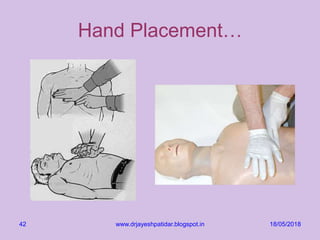 18/05/2018www.drjayeshpatidar.blogspot.in42
Hand Placement…
 