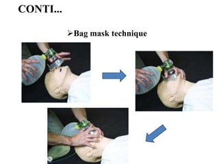 Bagging Mask Cardiopulmonary resuscitation (CPR) | PPTX