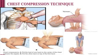 CHEST COMPRESSION TECHNIQUE
 