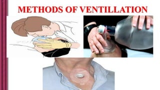METHODS OF VENTILLATION
 