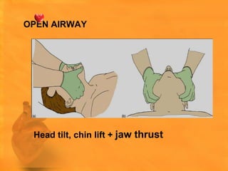OPEN AIRWAY




 Head tilt, chin lift + jaw thrust
 