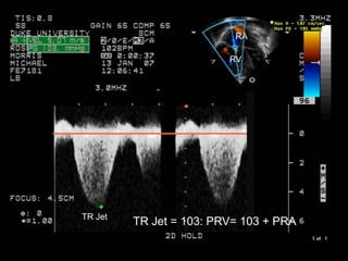 Cardiorespiratory Interactions