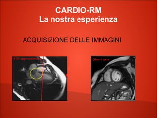 CARDIO-RM
La nostra esperienza
ACQUISIZIONE DELLE IMMAGINI
 