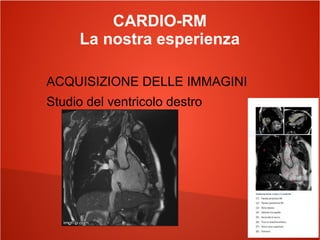CARDIO-RM
La nostra esperienza
ACQUISIZIONE DELLE IMMAGINI
Studio del ventricolo destro
 