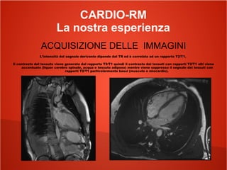 CARDIO-RM
La nostra esperienza
ACQUISIZIONE DELLE IMMAGINI
L’intensità del segnale derivante dipende dal TR ed è correlata ad un rapporto T2/T1.
Il contrasto del tessuto viene generato dal rapporto T2/T1 quindi il contrasto dei tessuti con rapporti T2/T1 alti viene
accentuato (liquor cerebro spinale, acqua e tessuto adiposo) mentre viene soppresso il segnale dei tessuti con
rapporti T2/T1 particolarmente bassi (muscolo e miocardio).
 