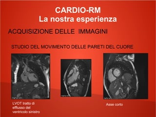 CARDIO-RM
La nostra esperienza
ACQUISIZIONE DELLE IMMAGINI
STUDIO DEL MOVIMENTO DELLE PARETI DEL CUORE
LVOT tratto di
efflusso del
ventricolo sinistro
Asse corto
 