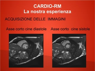 CARDIO-RM
La nostra esperienza
ACQUISIZIONE DELLE IMMAGINI
Asse corto cine diastole Asse corto cine sistole
 