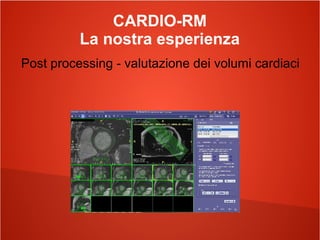 CARDIO-RM
La nostra esperienza
Post processing - valutazione dei volumi cardiaci
 
