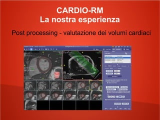 CARDIO-RM
La nostra esperienza
Post processing - valutazione dei volumi cardiaci
 