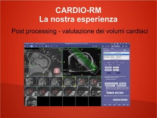 CARDIO-RM
La nostra esperienza
Post processing - valutazione dei volumi cardiaci
 