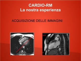 CARDIO-RM
La nostra esperienza
ACQUISIZIONE DELLE IMMAGINI
 