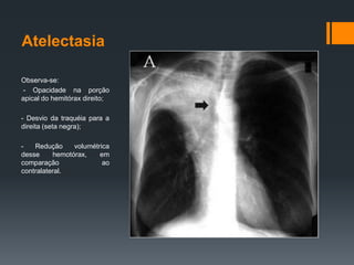 Atelectasia
Observa-se:
- Opacidade na porção
apical do hemitórax direito;
- Desvio da traquéia para a
direita (seta negra);
Redução
volumétrica
desse
hemotórax,
em
comparação
ao
contralateral.

 