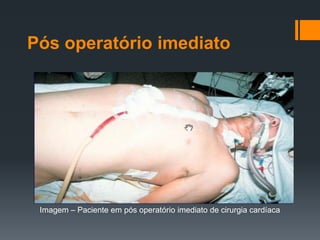 Pós operatório imediato

Imagem – Paciente em pós operatório imediato de cirurgia cardíaca

 