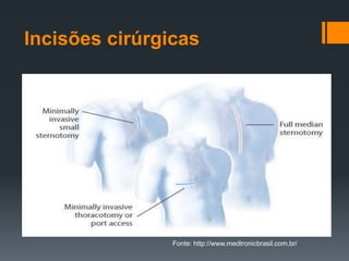 Incisões cirúrgicas

Fonte: http://www.medtronicbrasil.com.br/

 