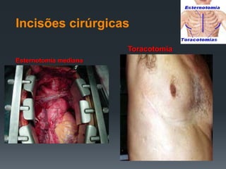 Incisões cirúrgicas
Toracotomia
Esternotomia mediana

 