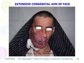 cardiothoracic and vascular surgery in sulaimani the begining.pdf