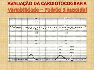 AVALIAÇÃO DA CARDIOTOCOGRAFIA
 