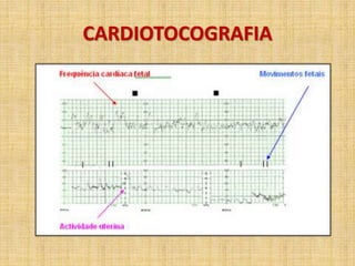 CARDIOTOCOGRAFIA
 