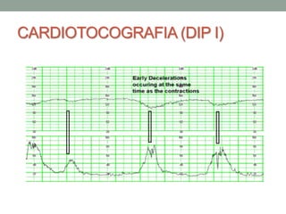 CARDIOTOCOGRAFIA (DIP I)
 