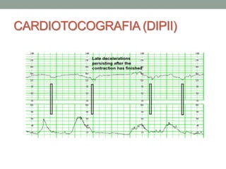 CARDIOTOCOGRAFIA (DIPII)
 