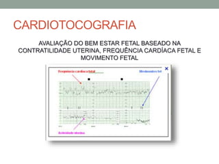 CARDIOTOCOGRAFIA
AVALIAÇÃO DO BEM ESTAR FETAL BASEADO NA
CONTRATILIDADE UTERINA, FREQUÊNCIA CARDÍACA FETAL E
MOVIMENTO FETAL
 