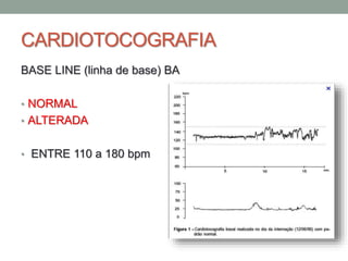 CARDIOTOCOGRAFIA
BASE LINE (linha de base) BA
• NORMAL
• ALTERADA
• ENTRE 110 a 180 bpm
 