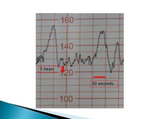 5 beats


          30 seconds
 