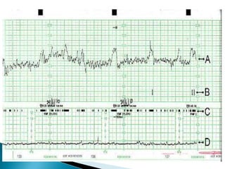 Cardiotocograph | PPTX