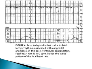 FIGURE 4. Fetal tachycardia that is due to fetal
tachyarrhythmia associated with congenital
anomalies, in this case, ventricular septal defect.
Fetal heart rate is 180 bpm. Notice the "spike"
pattern of the fetal heart rate.
 