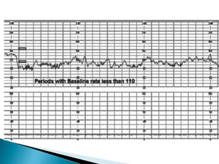 Cardiotocograph | PPTX