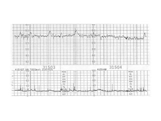 Cardiotocography | PDF