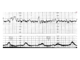 Cardiotocography | PDF