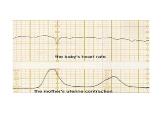 Cardiotocography | PDF
