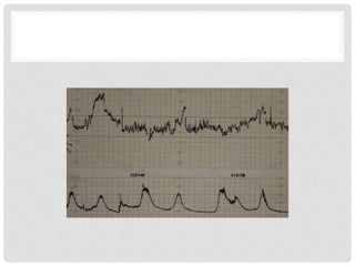 Cardiotocography | PPTX