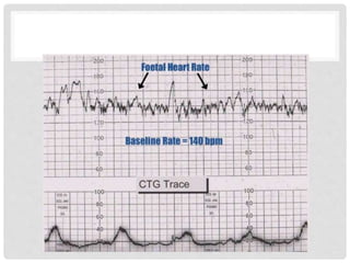 Cardiotocography | PPTX