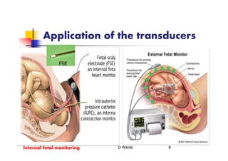 Application of the transducers
O Warda 8Internal fetal monitoring
FSE
 