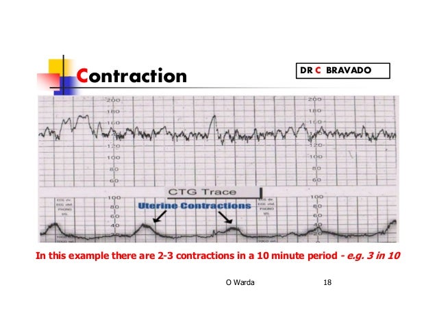 Contraction Monitor Chart