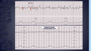 Cardiotocography | PPTX