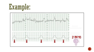 Comprehensive Guide to Continuous CTG Monitoring in Pregnancy | PDF