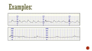 Comprehensive Guide to Continuous CTG Monitoring in Pregnancy | PDF