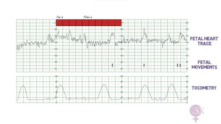 Comprehensive Guide to Continuous CTG Monitoring in Pregnancy | PDF