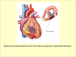 External and cross-sectional view of an infarct caused by a myocardial infarction.
 