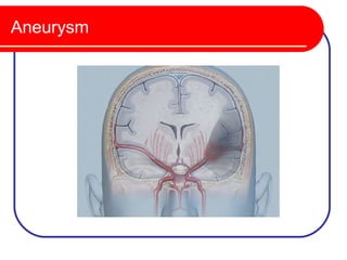 Aneurysm
 