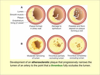 Development of an atherosclerotic plaque that progressively narrows the
lumen of an artery to the point that a thrombus fully occludes the lumen.
 