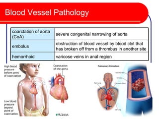 Blood Vessel Pathology

 coarctation of aorta
                        severe congenital narrowing of aorta
 (CoA)
                        obstruction of blood vessel by blood clot that
 embolus
                        has broken off from a thrombus in another site
 hemorrhoid             varicose veins in anal region
 