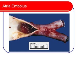 Atria Embolus
 